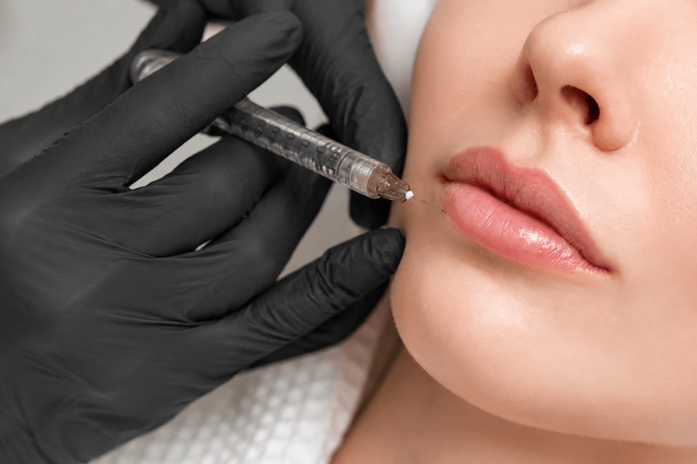 Behandlung der Lippen mit Hyaluronsäure-Filler