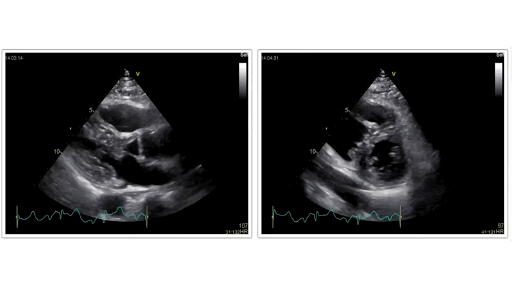 Echocardiogram imaging in progress