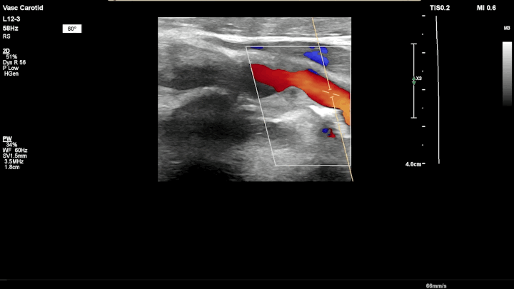 Carotid Doppler ultrasound image