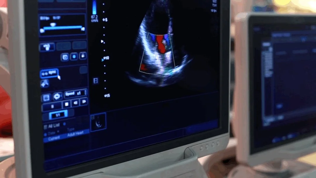 Echocardiogram