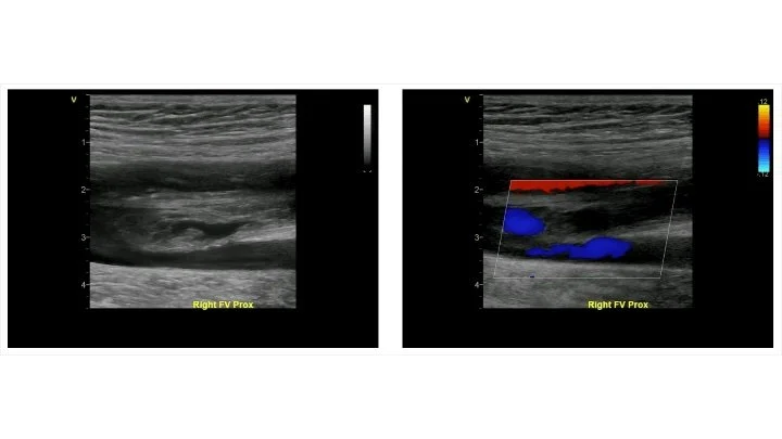 DVT Ultrasound