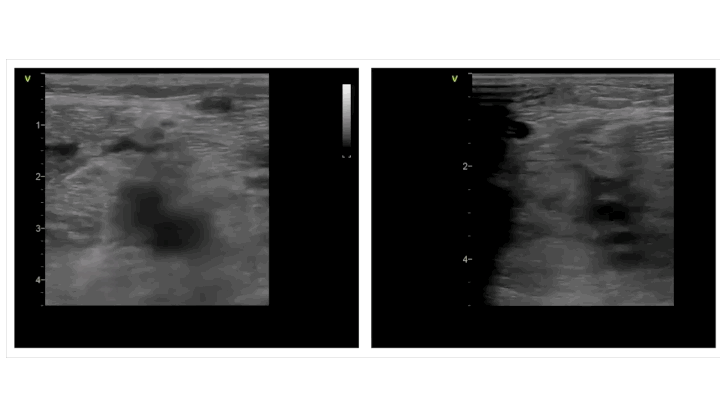 Lower-extremity venous ultrasound image