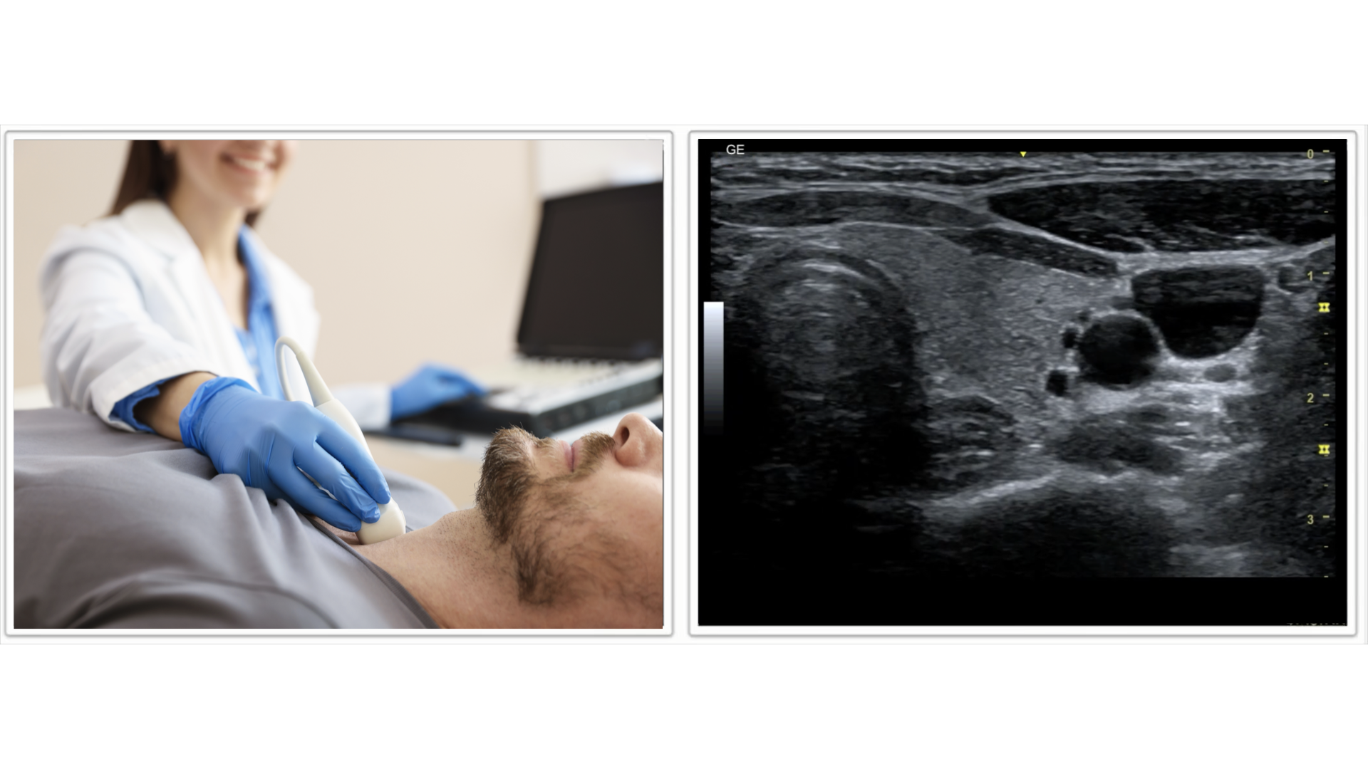 Thyroid ultrasound imaging