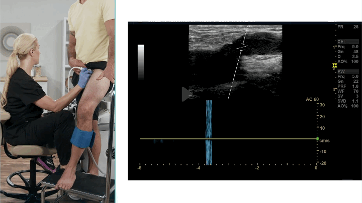 Venous reflux Doppler ultrasound image