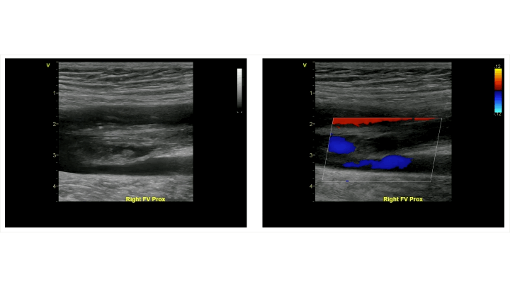 DVT Doppler ultrasound image