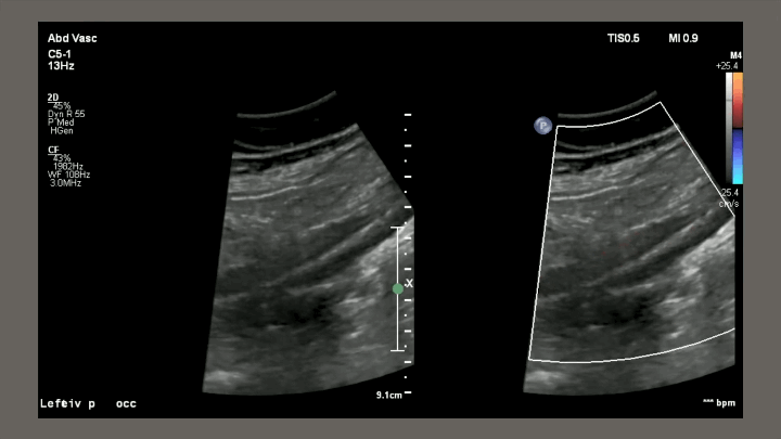 Peripheral arterial Doppler ultrasound image