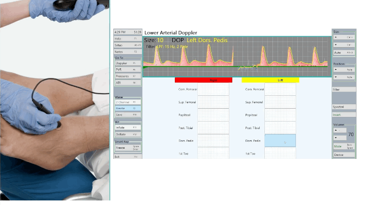 PVR pulse volume recording waveform imaging