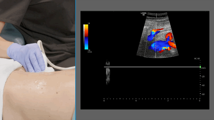 IVC Doppler ultrasound image