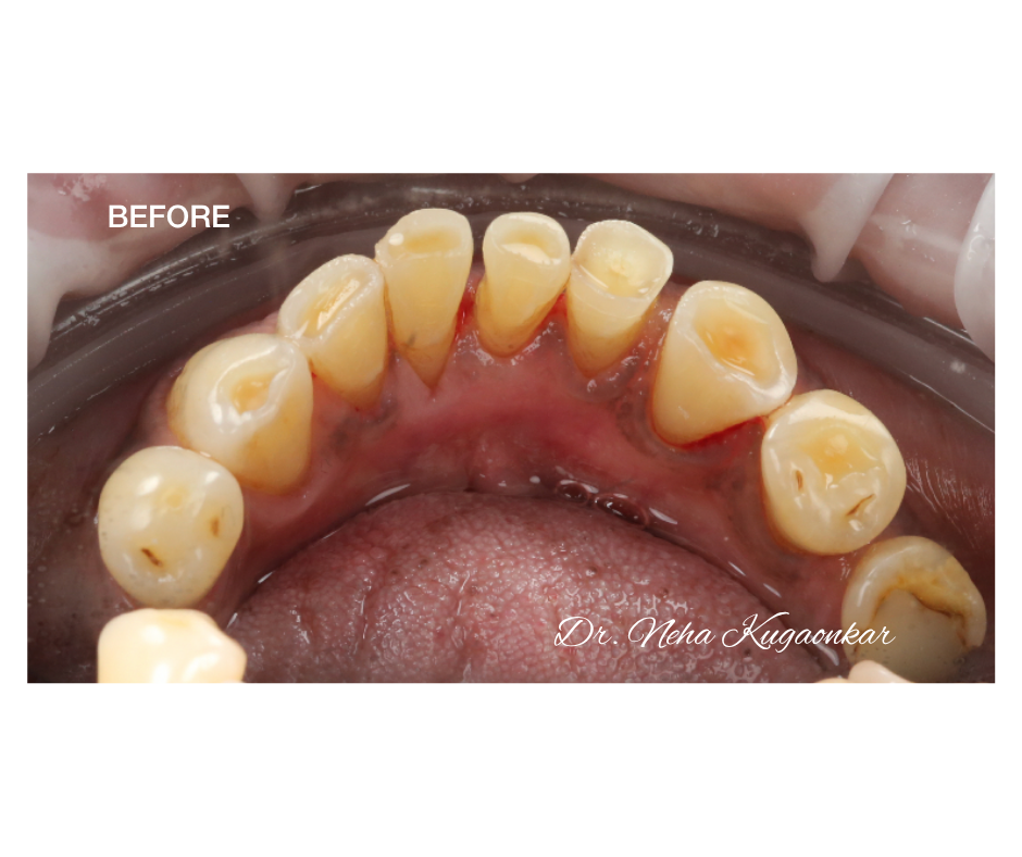 Case Study 4 view 2 before veneer treatment