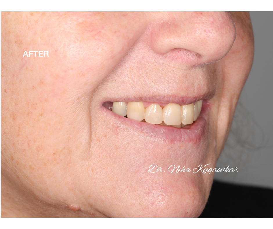 Case Study 5 view 2 after veneer treatment