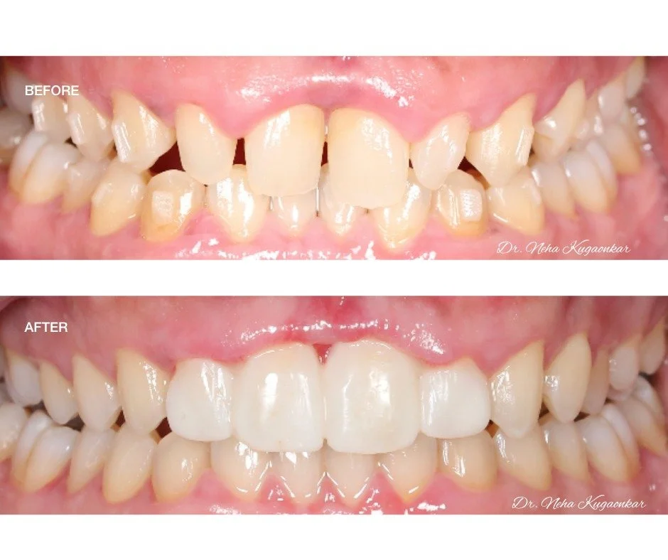 SureSmile case showing anterior and posterior alignment improvement