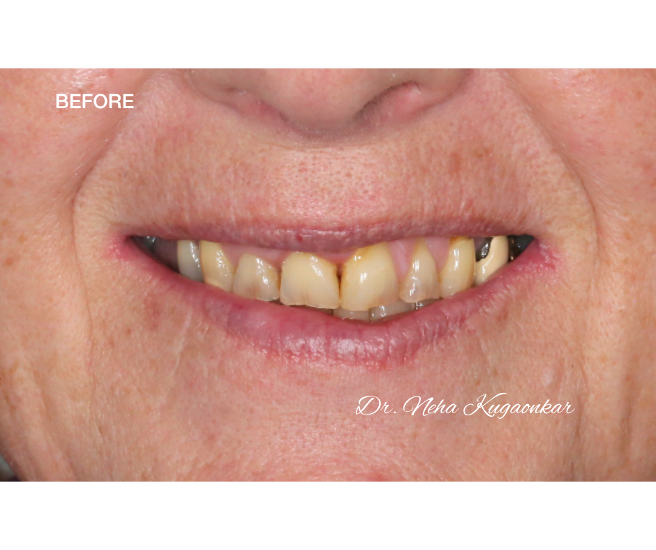 Case Study 5 view 1 before veneer treatment
