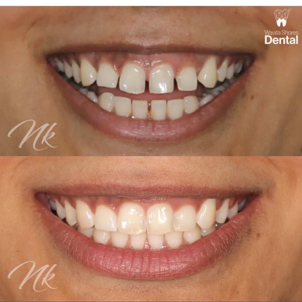 SureSmile before and after smile transformation