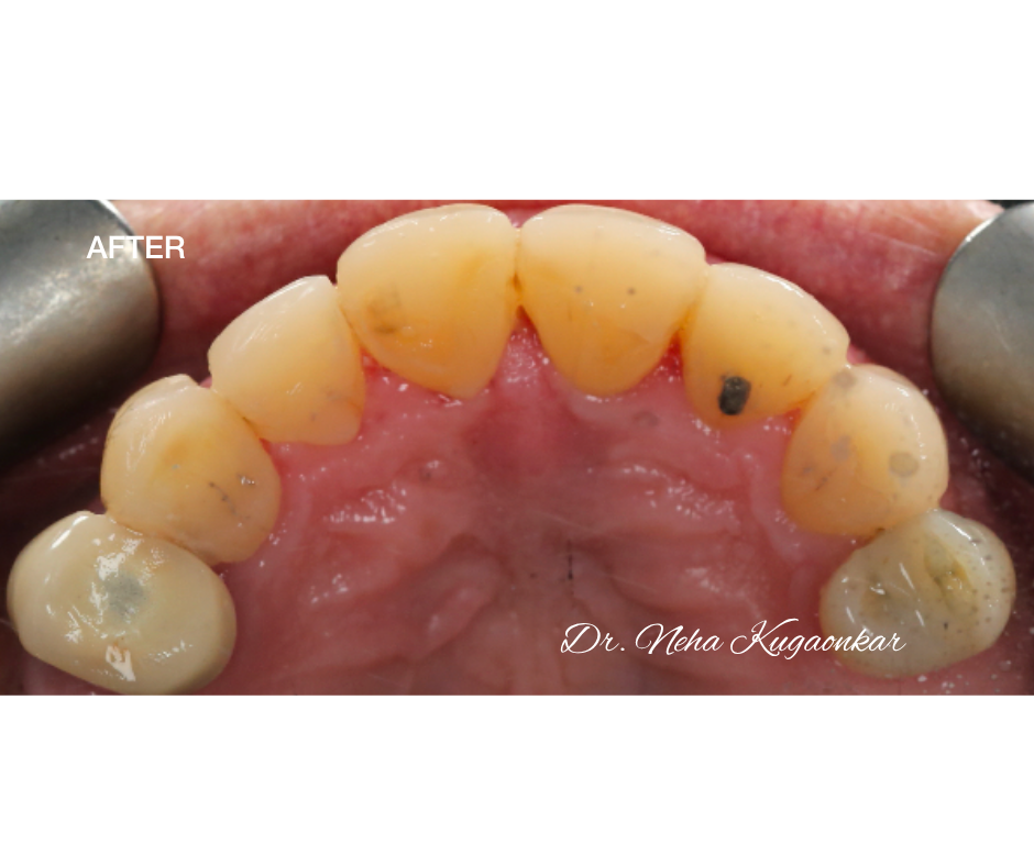 Case Study 5 view 5 after veneer treatment