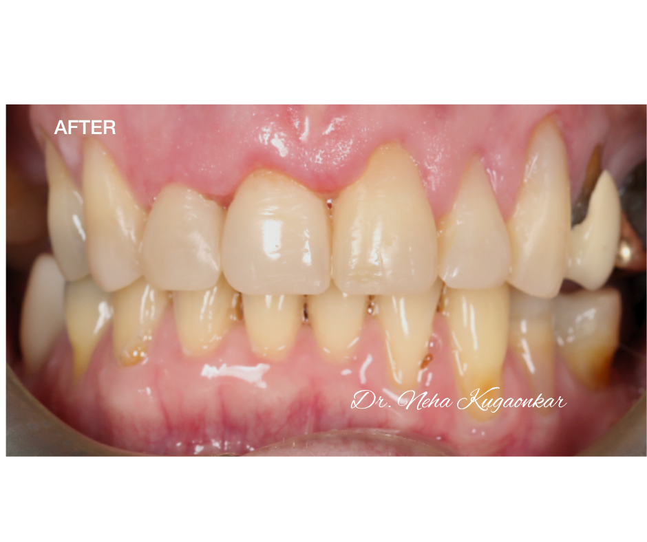 Case Study 5 view 4 after veneer treatment