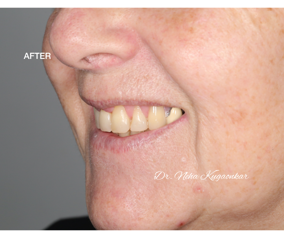 Case Study 5 view 3 after veneer treatment