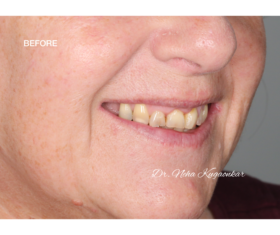 Case Study 5 view 2 before veneer treatment