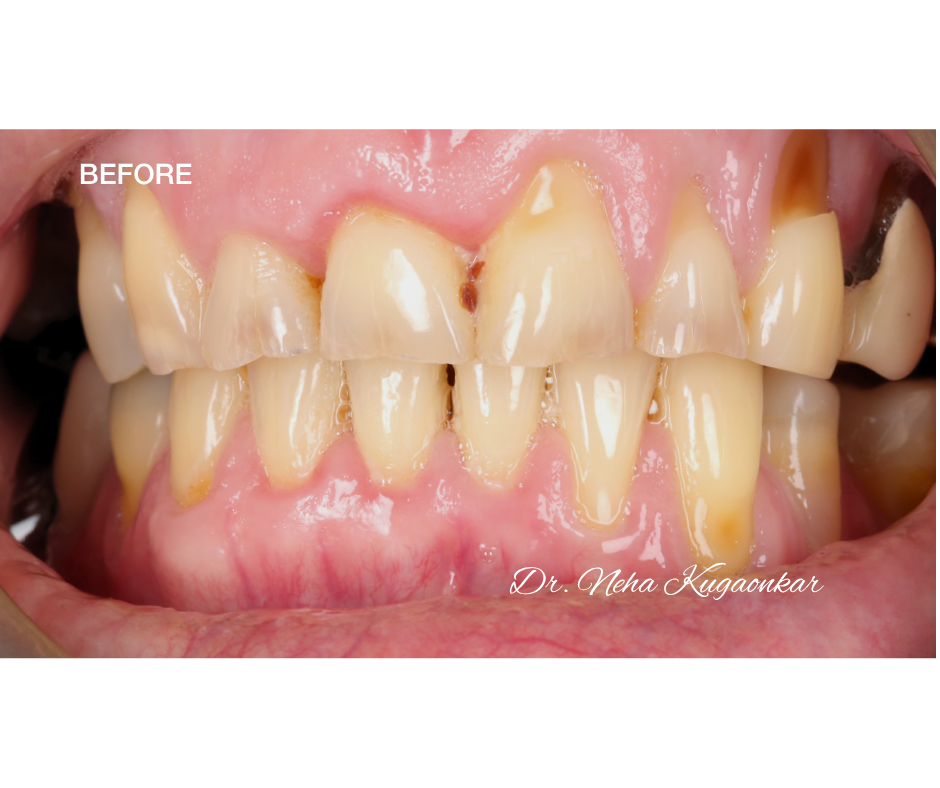 Case Study 5 view 4 before veneer treatment