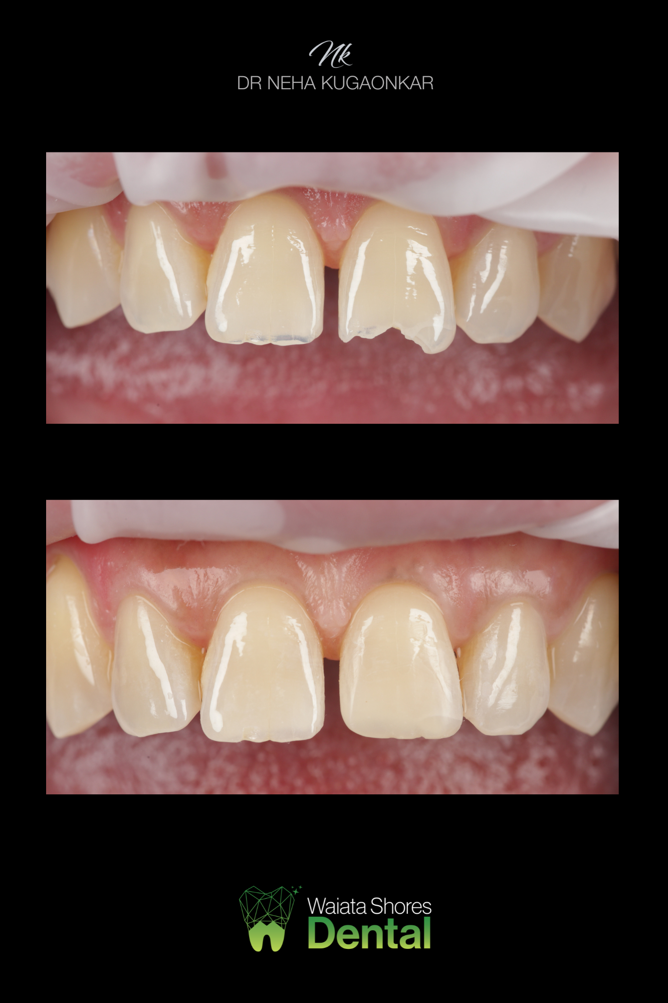 Smile makeover before and after result 2