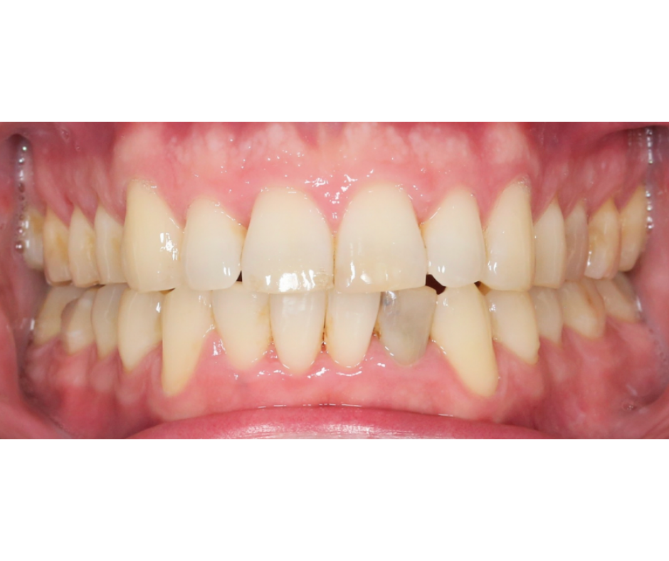 Case Study 2 following orthodontic alignment