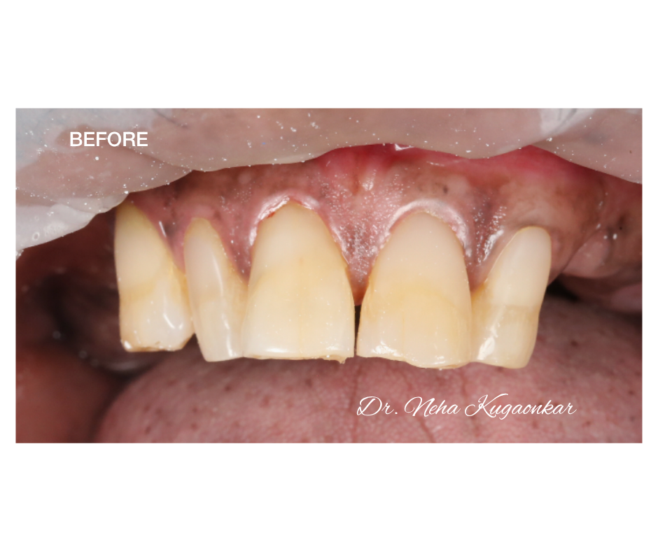 Case Study 4 view 1 before veneer treatment