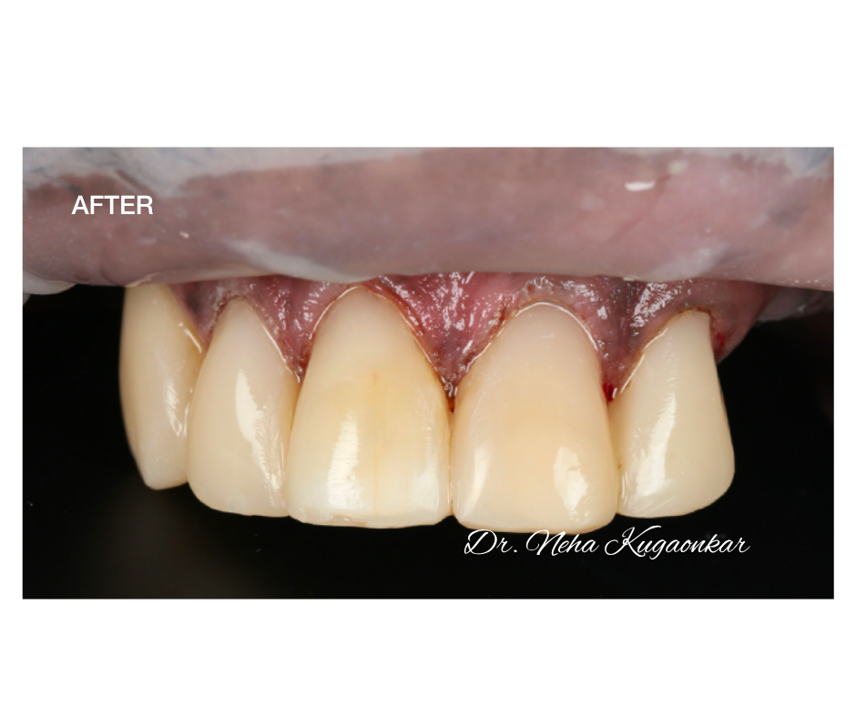 Case Study 4 view 1 after veneer treatment