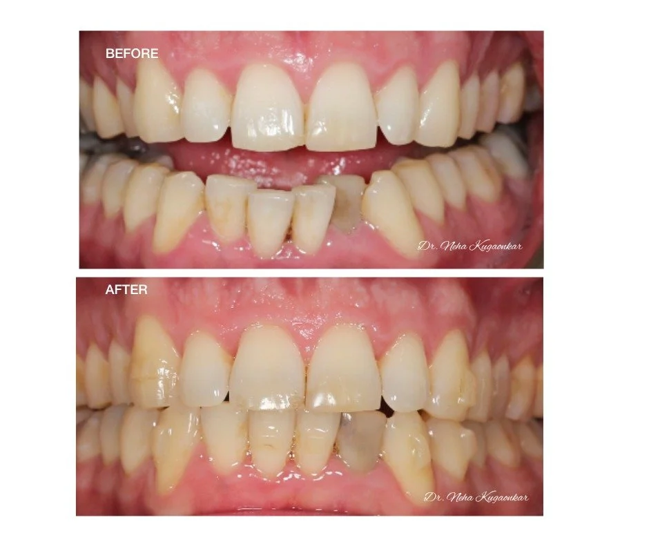 SureSmile staged smile correction case