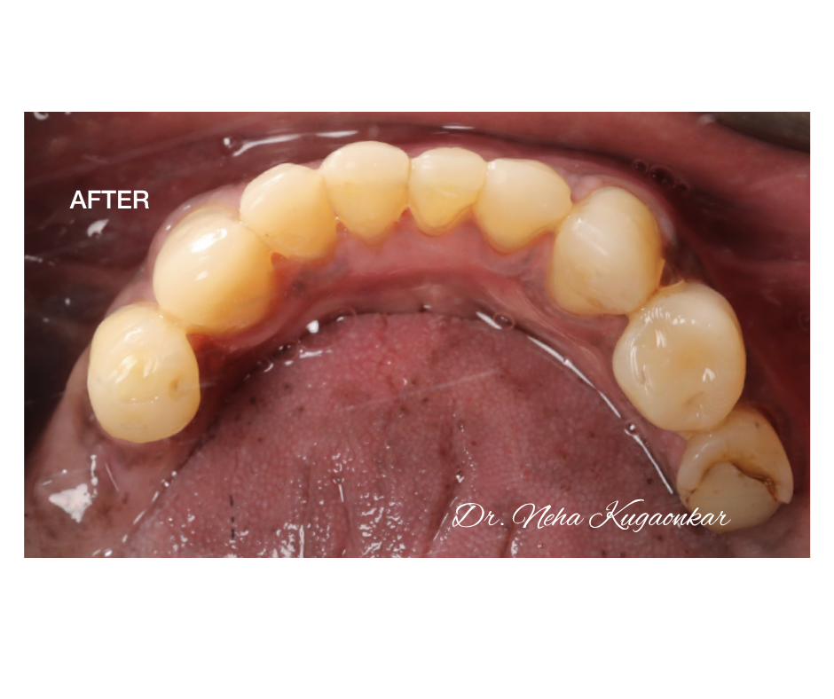 Case Study 4 view 2 after veneer treatment