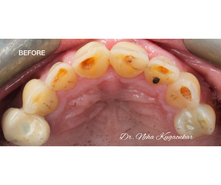 Case Study 5 view 5 before veneer treatment