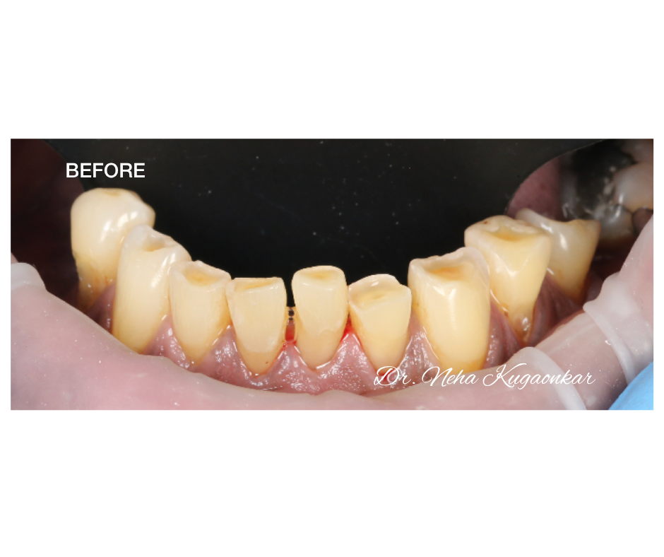 Case Study 4 view 3 before veneer treatment