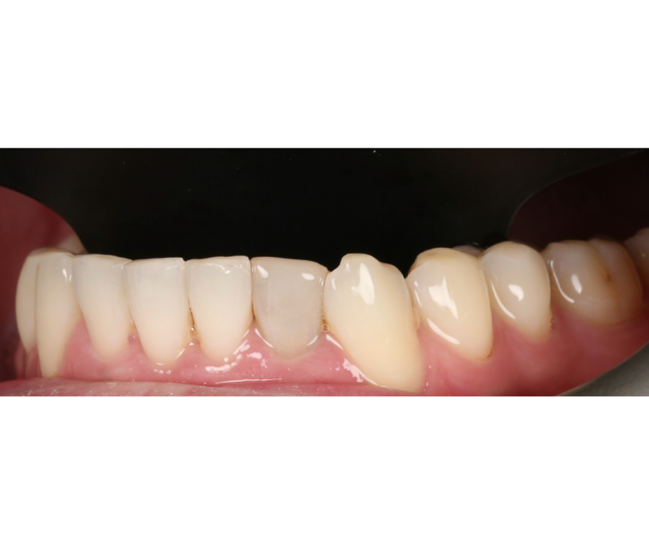 Prepared tooth in Case Study 2