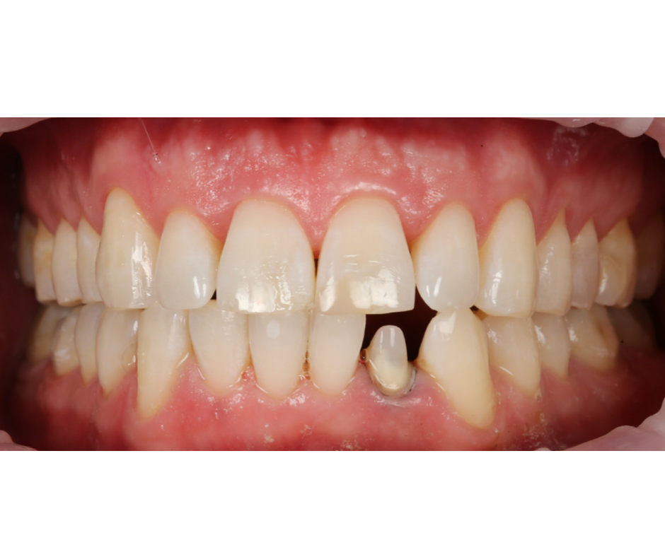 Case Study 2 crown preparation