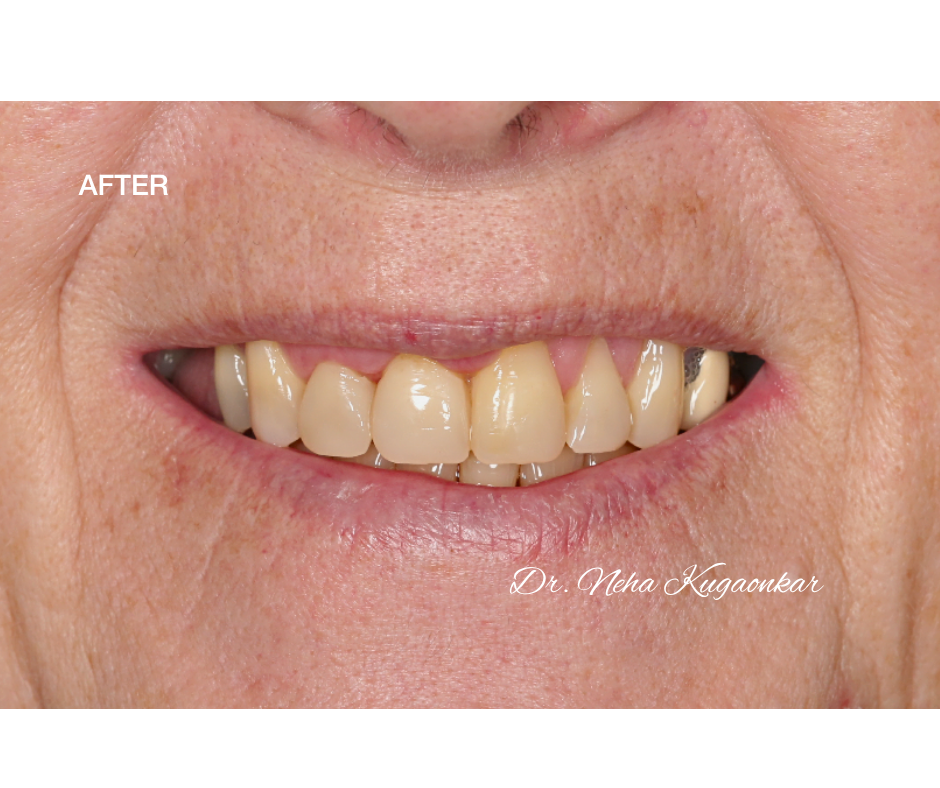 Case Study 5 view 1 after veneer treatment