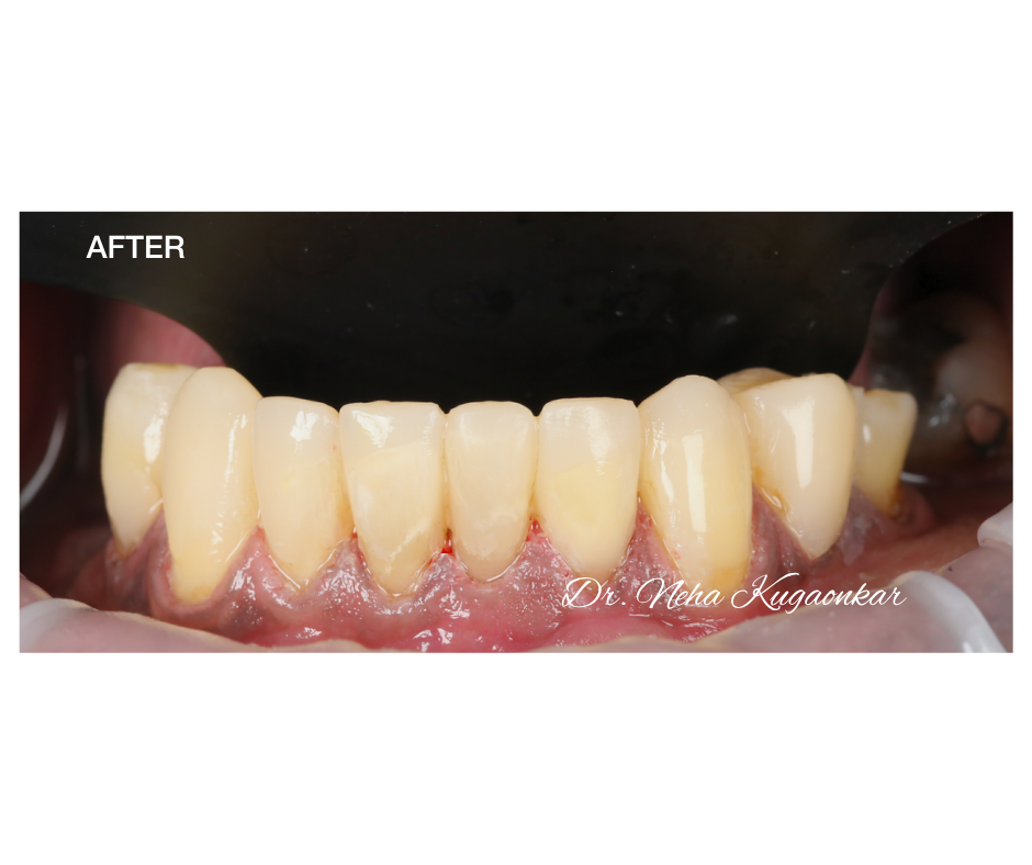 Case Study 4 view 3 after veneer treatment