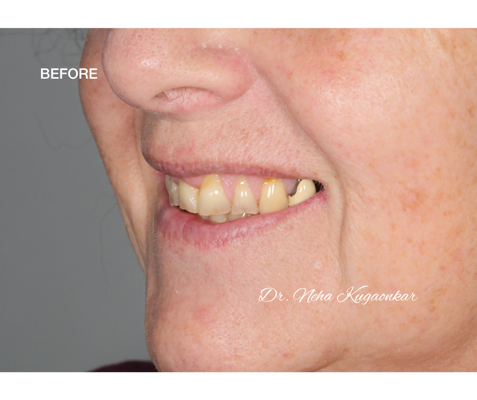 Case Study 5 view 3 before veneer treatment
