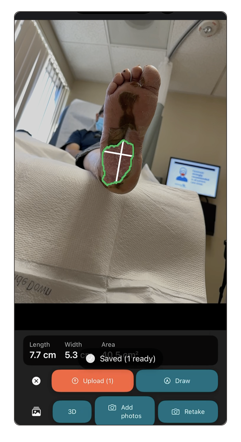 WoundScribe guided capture screen
