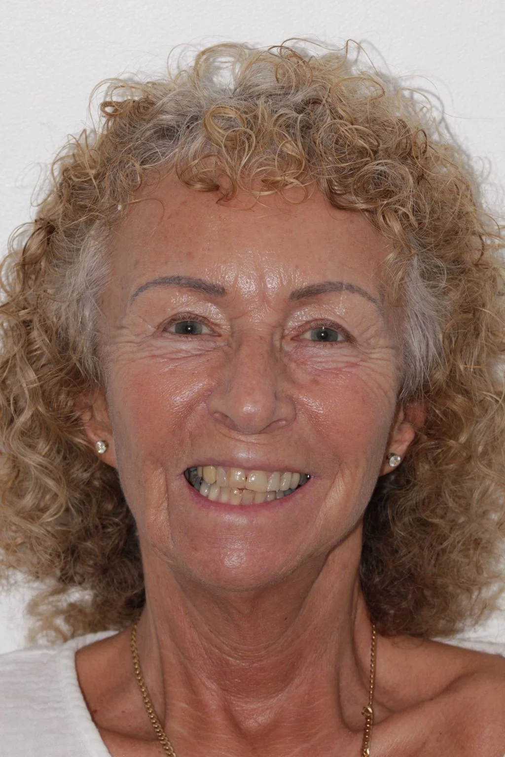 Matching smiling portrait before treatment