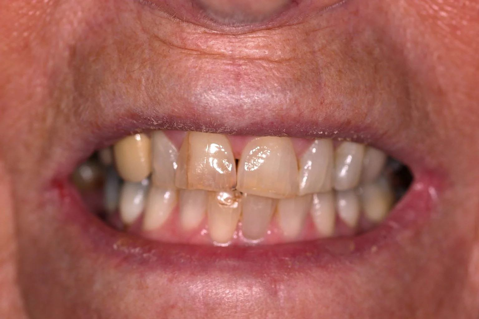 Matching close-up before treatment, showing worn and discoloured upper incisors