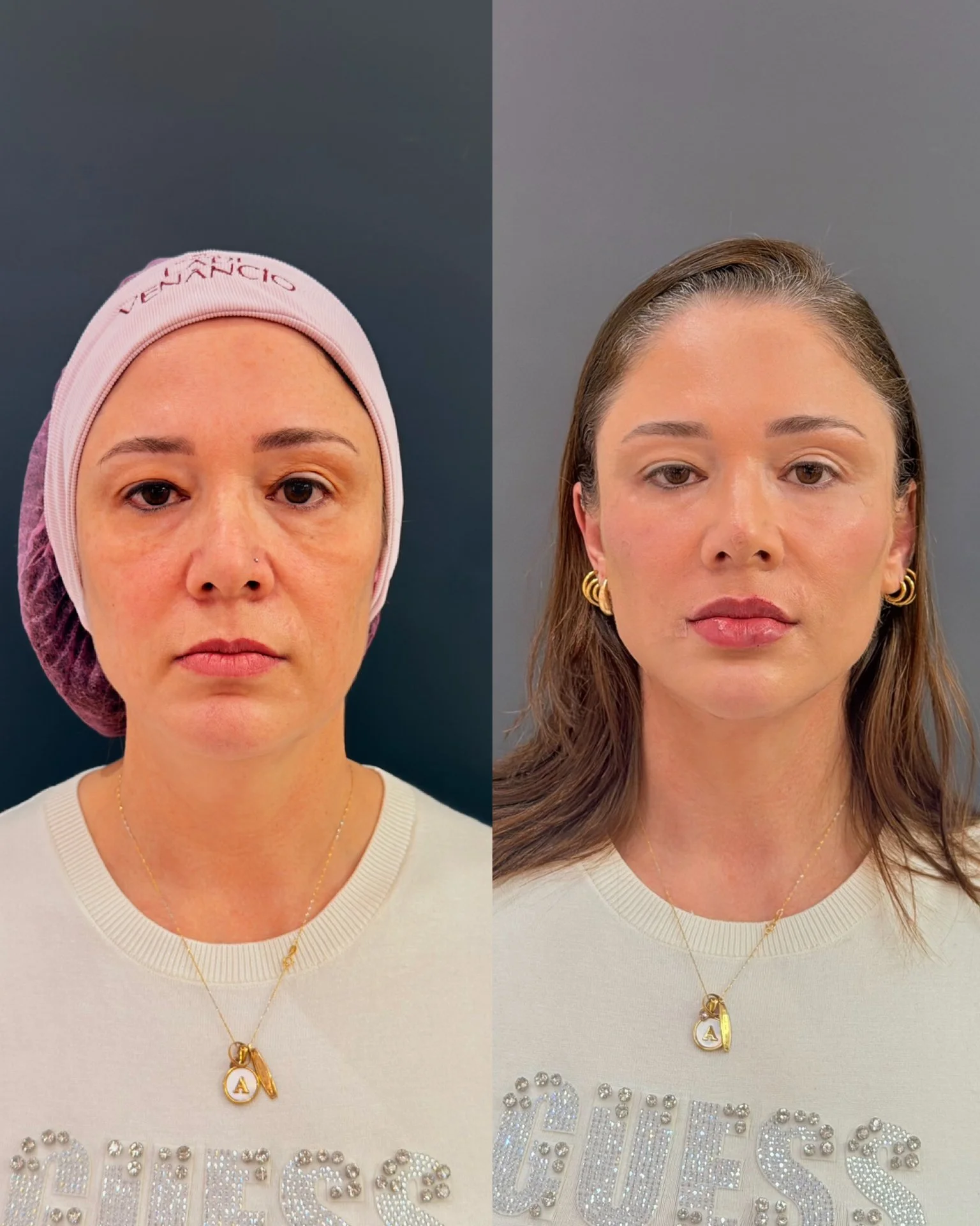 Full Face Filler before and after result