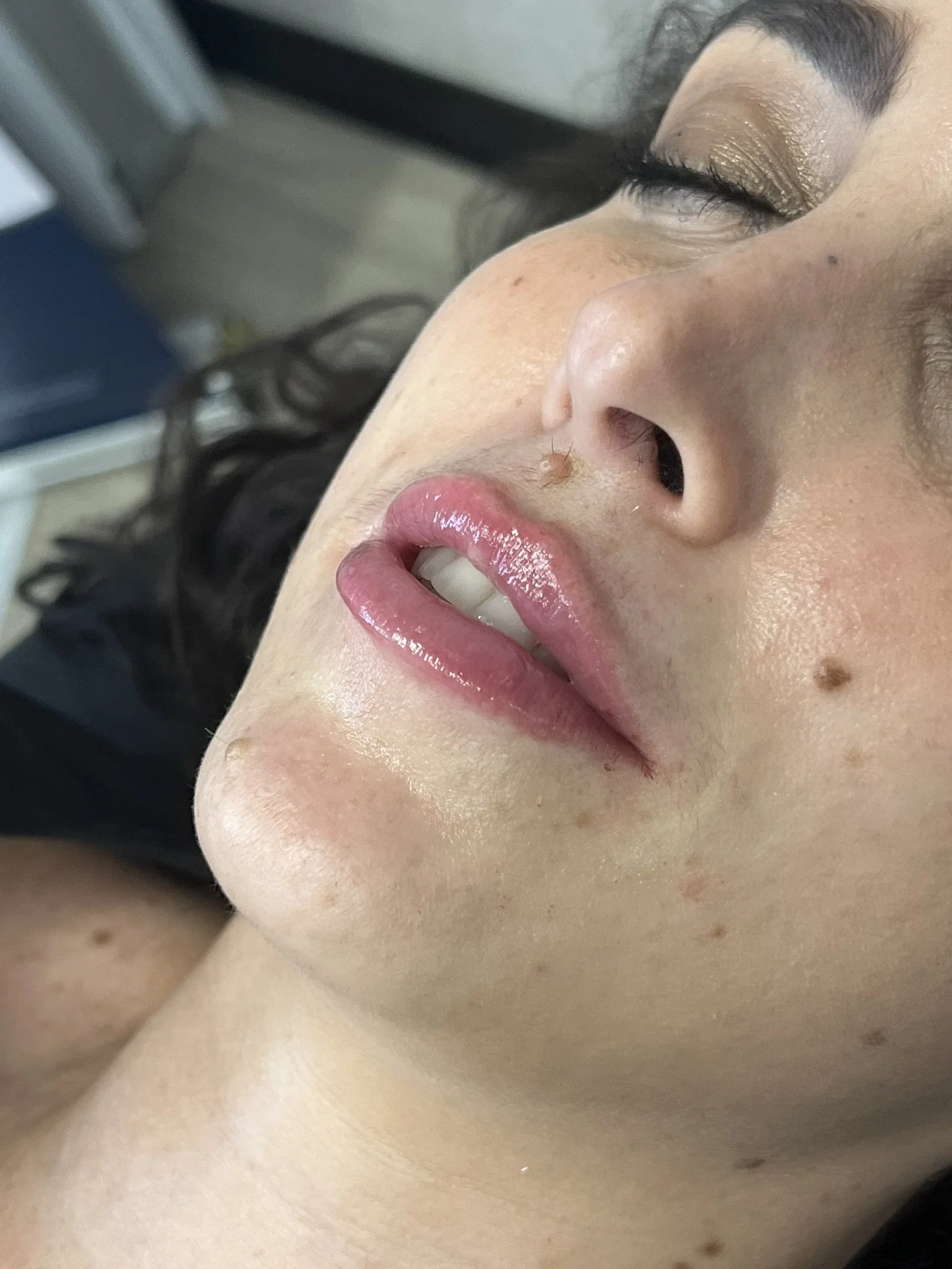 Lip Filler before and after result