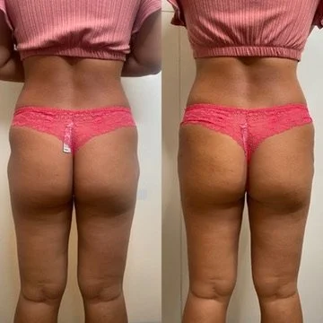 Body Contouring before and after result