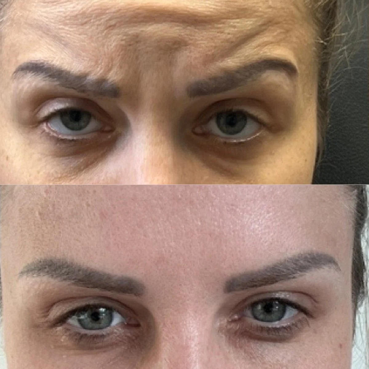 Botox before and after result