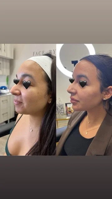 Full Face Filler before and after result