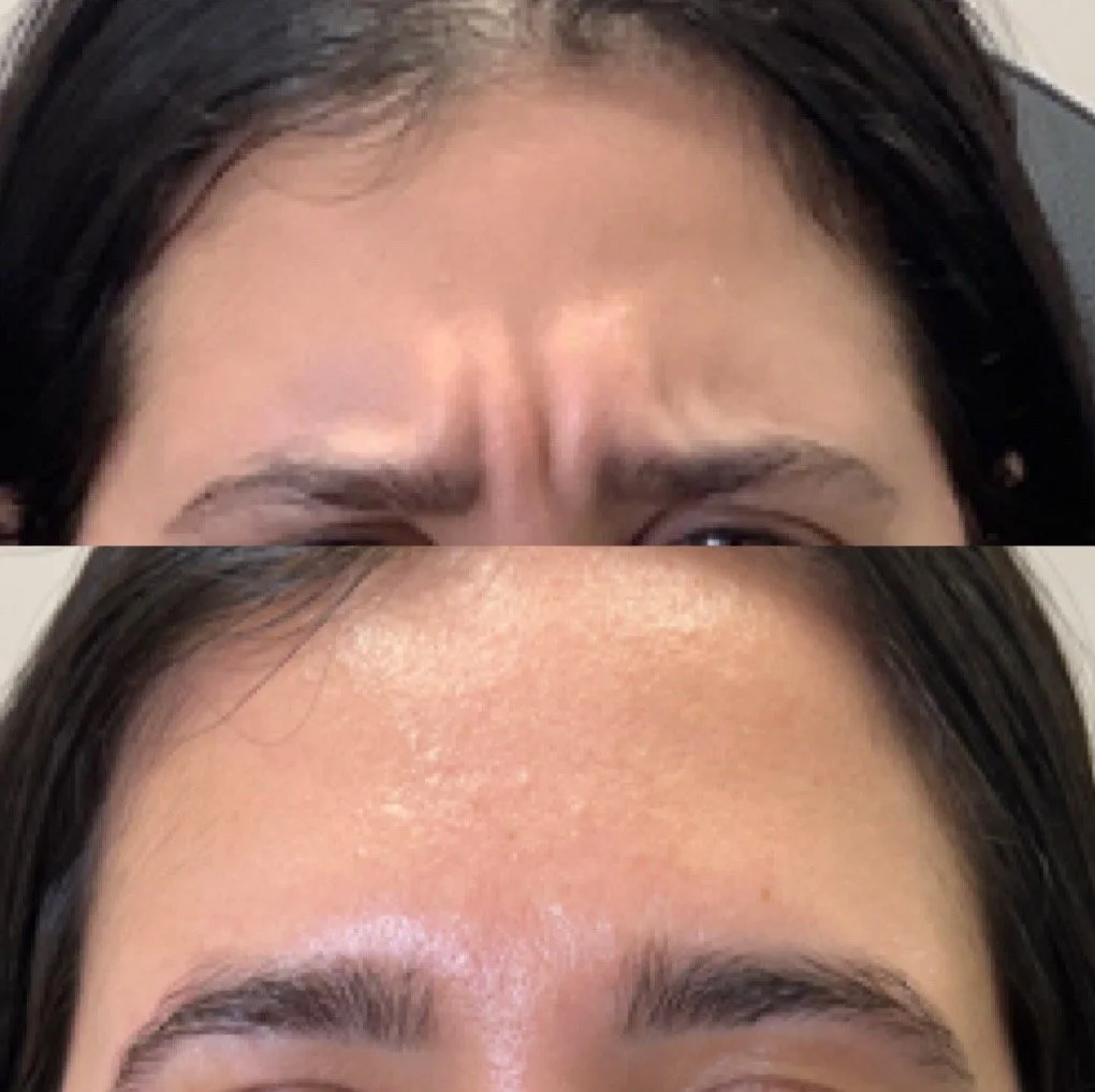 Botox before and after result