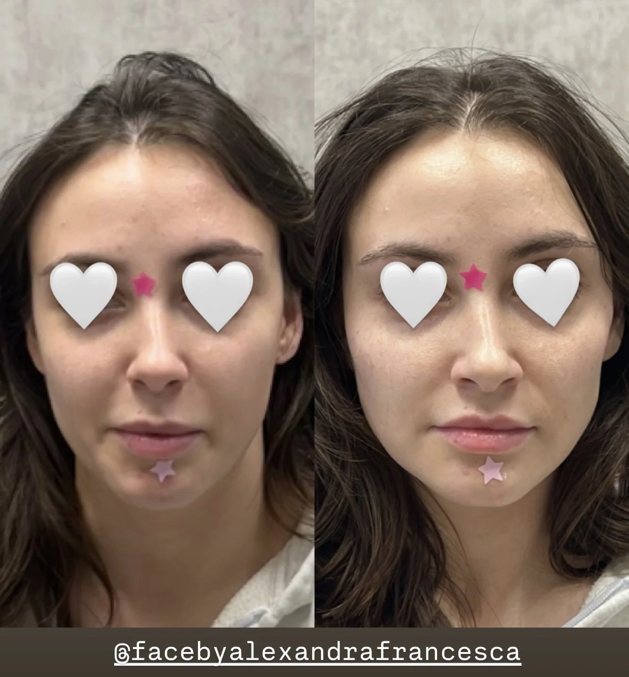 Cheek Filler before and after result