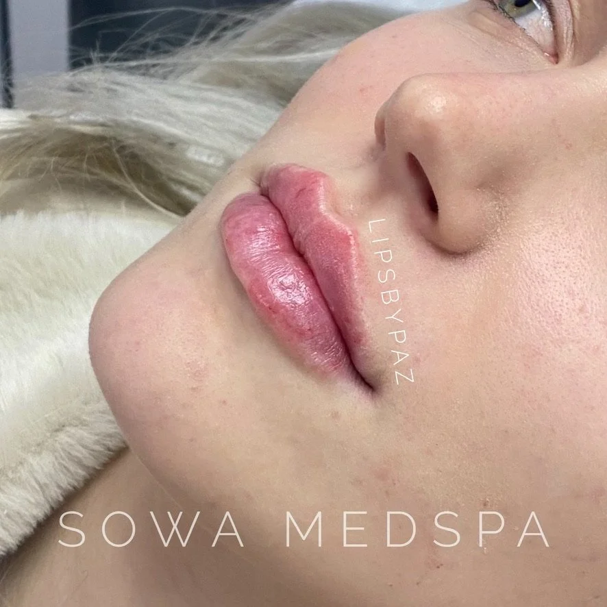 Lip Filler before and after result