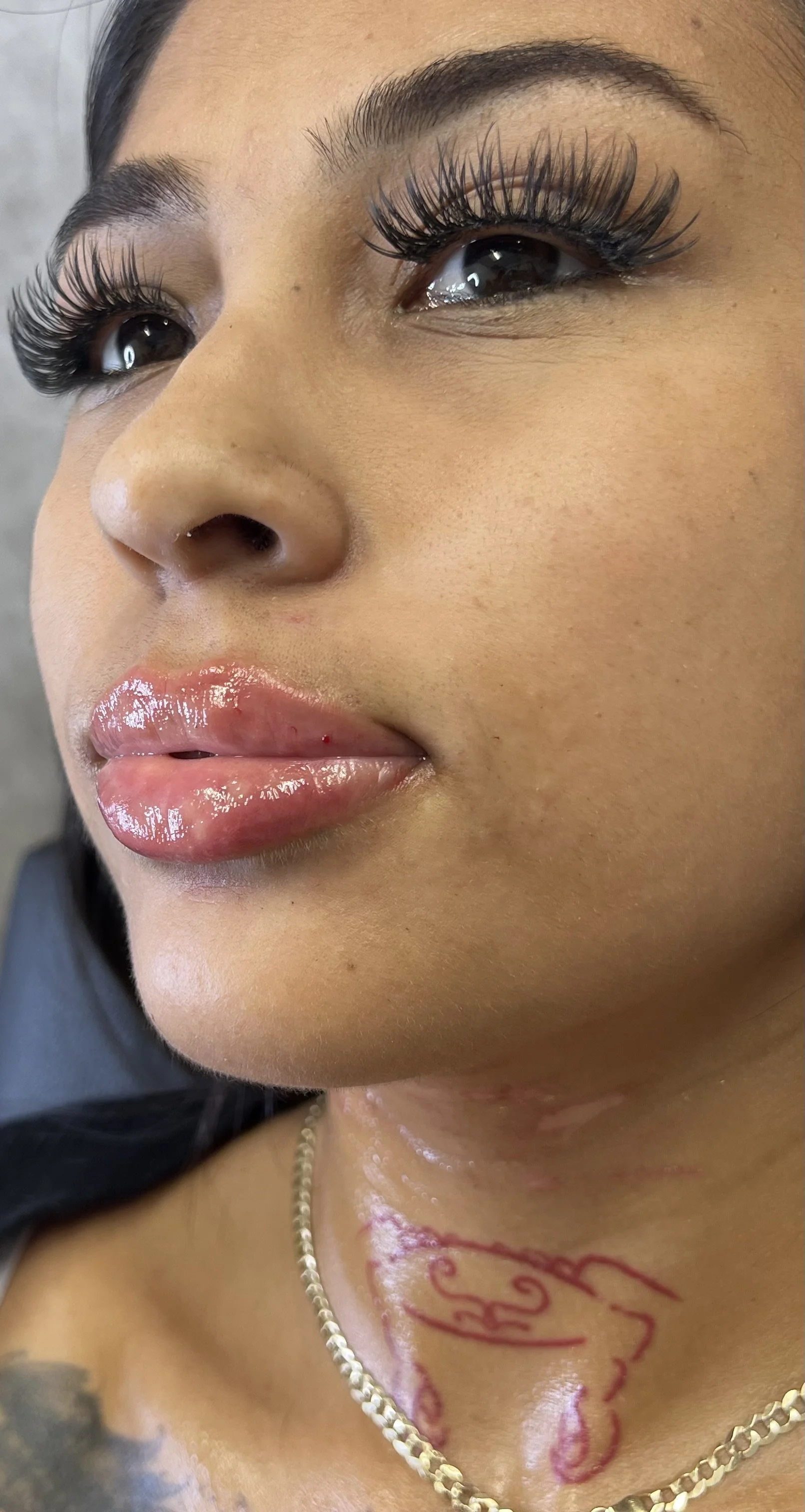 Lip Filler before and after result