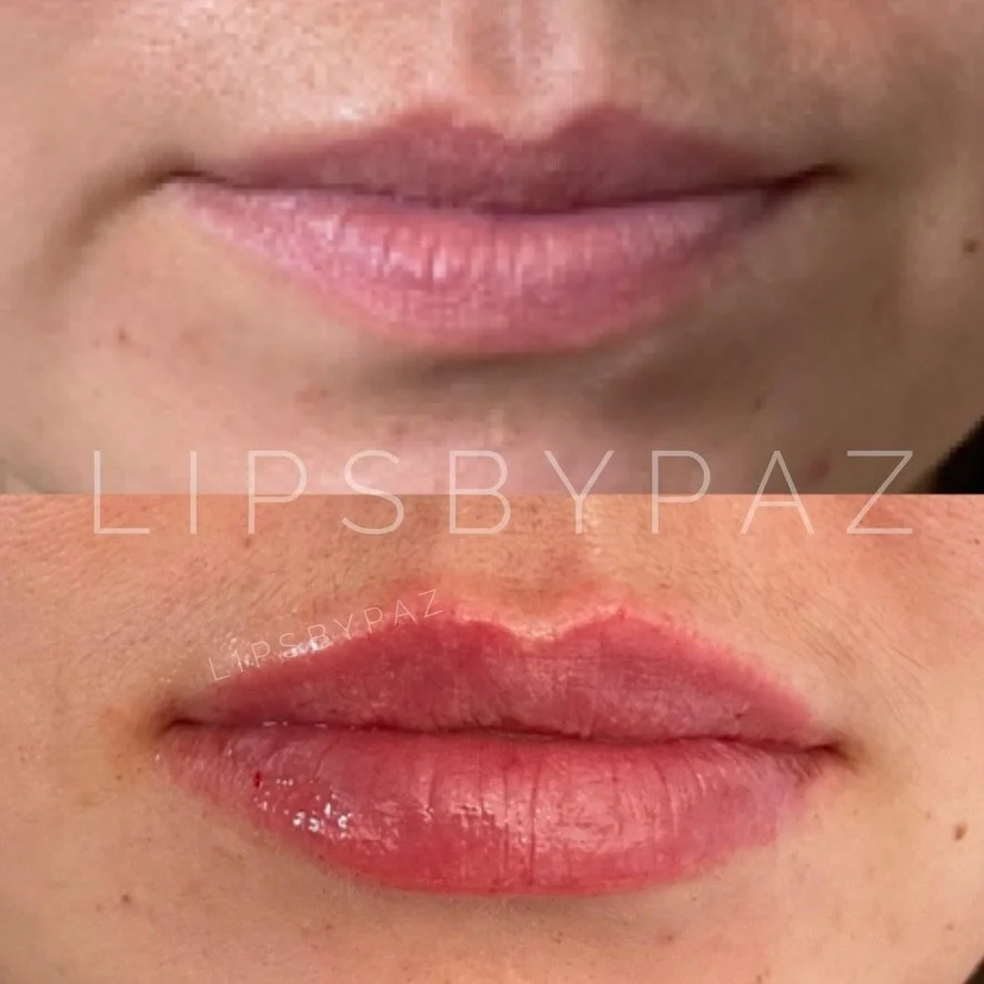 Lip Filler before and after result