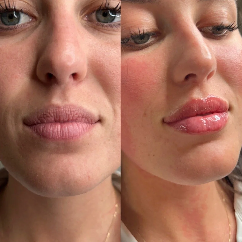 Lip Filler before and after result