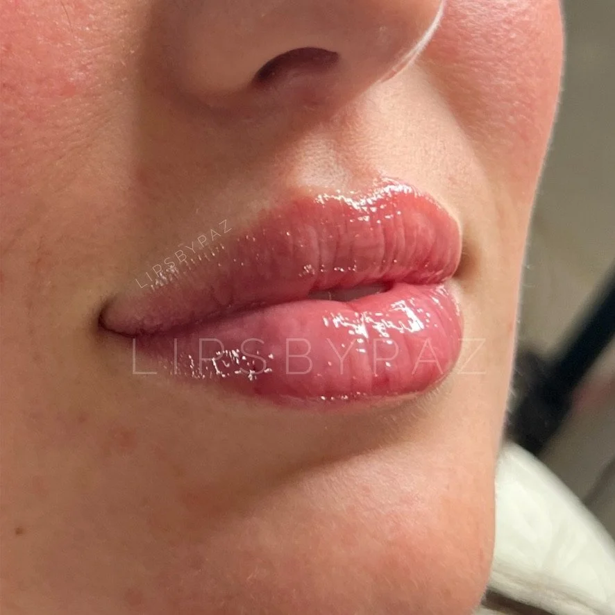Lip Filler before and after result